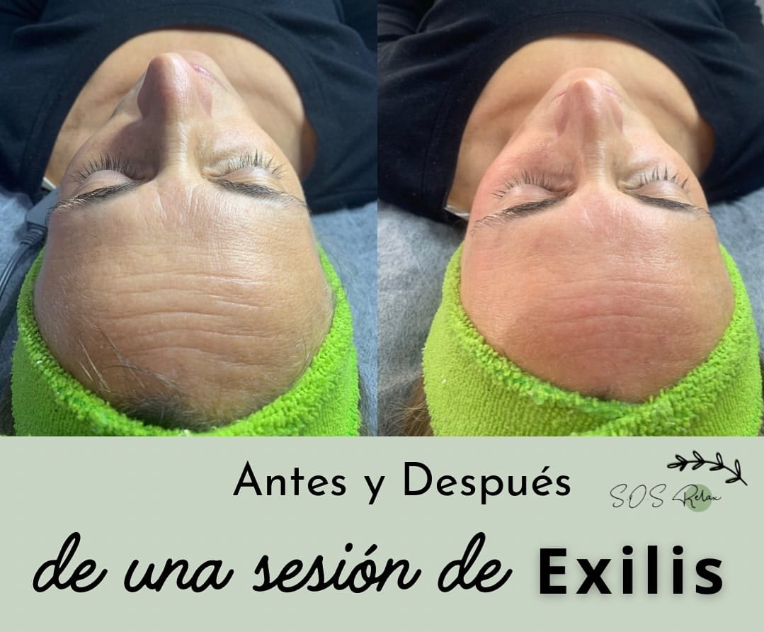 Antes y después de una sesión de Exilis en el rostro