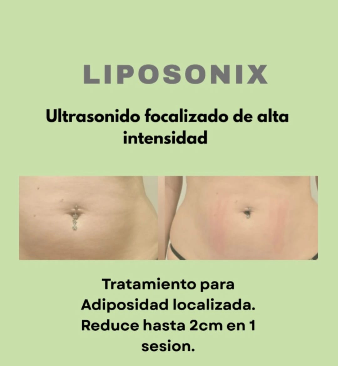 Antes y después de Liposonix en el abdomen